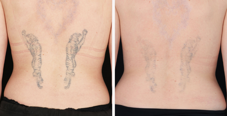 Complications in Tattoo Removal: Understanding the Risks